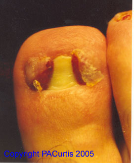 Ingrown nail - bilateral
